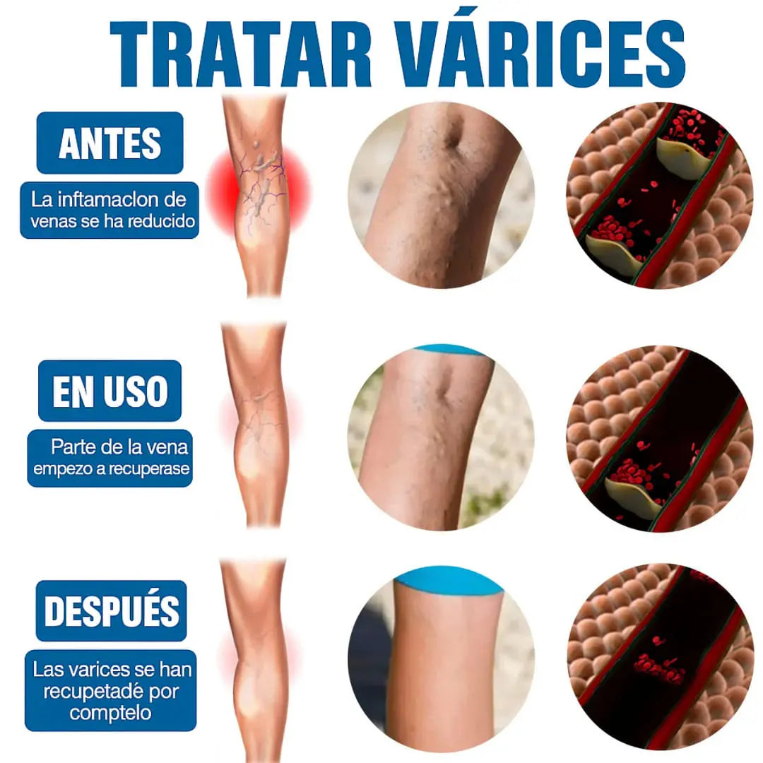 Venaderm Pro® - Spray Terapéutico para Várices